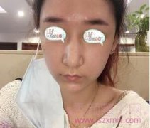 上海隆鼻失败修复案例