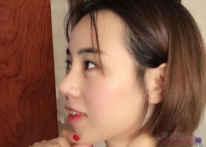 上海伯思立韩嘉毅给我做的半肋软骨鼻部手术