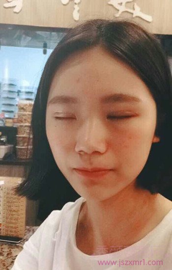 全切双眼皮术后一个月了,持续更~~~~~