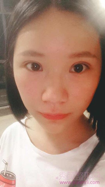 全切双眼皮术后一个月了,持续更~~~~~