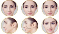 <b>Pst面部提升术-李晓东做面部提升怎么样</b>