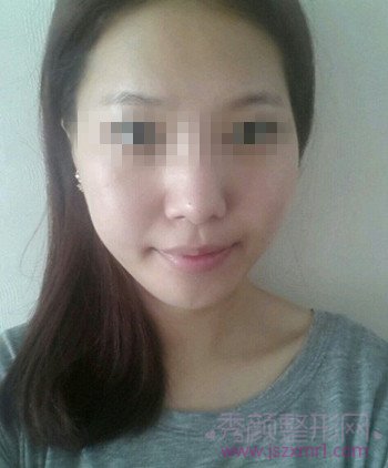 小仙女们，快来看看做了隆鼻的我变漂亮了吗？