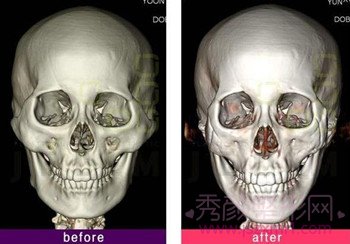 【科普】颧骨内推手术方法 术前术后图片对比