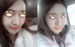 <b>【科普】颧骨内推手术方法 术前术后图片对比</b>