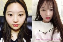 【北京隆鼻】王军、曾高、罗汇东谁隆鼻技术好