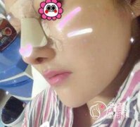 鼻子修复两次了，北京柏丽李劲良修复鼻部手术