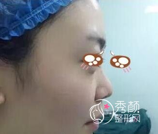 上海九院余力假体隆鼻手术过程分享