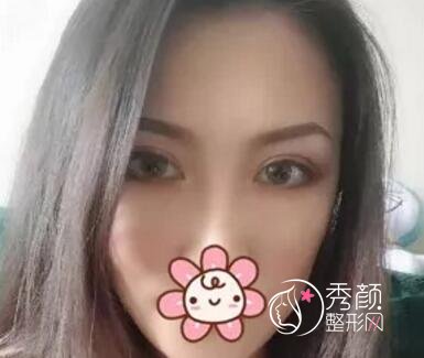 北京双眼皮修复案例分享。