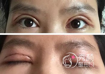 【案例分享】上海九院全切双眼皮恢复记录