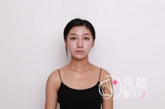 上海伊莱美李湘原磨骨怎么样,案例。