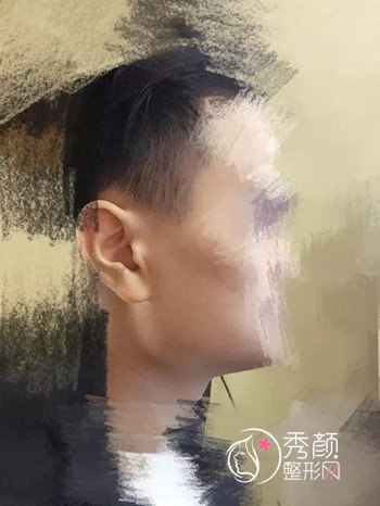 【磨骨案例】本人男,成都磨颧骨和下颌骨15天了