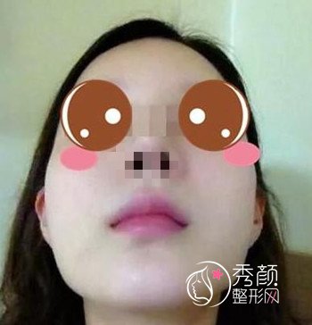 上海华美李志海磨骨怎么样,我做了颧骨和下颌角