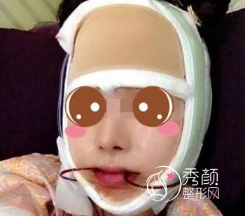 上海华美李志海磨骨怎么样,我做了颧骨和下颌角