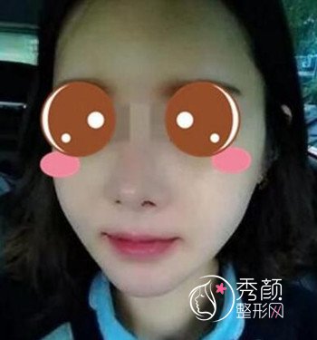 上海华美李志海磨骨怎么样,我做了颧骨和下颌角