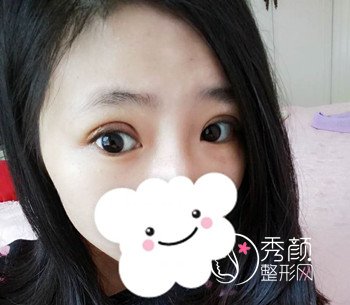 上海百达丽靠谱吗,我割了双眼皮。