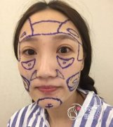 上海瑞芙臣医疗怎么样,自体脂肪填充隆鼻案例