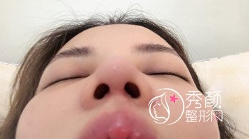 李保锴做鼻部手术怎么样,我觉得好看