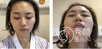 杭州华山连天美高俊明磨骨怎么样,快来看看。