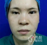 <b>上海伯思立徐晓斐双眼皮修复怎么样,感觉不错哟</b>