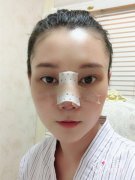 <b>上海伊莱美钱玉鑫全肋软骨隆鼻修复怎么样.</b>