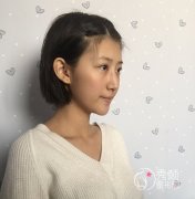 北京英煌整形超声提拉怎么样,皮肤松弛解决了