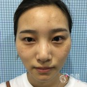 杭州格莱美做的眼部手术怎么样,好看吧?