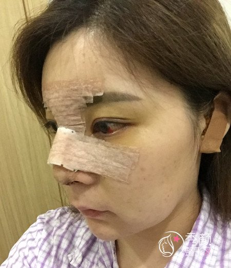 上海华美李健鼻部手术怎么样,案例。