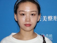 <b>上海伊莱美邱文苑隆鼻怎么样,案例来了。</b>