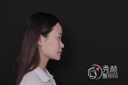 北京沃尔冯雁平硅胶隆鼻怎么样,案例图。