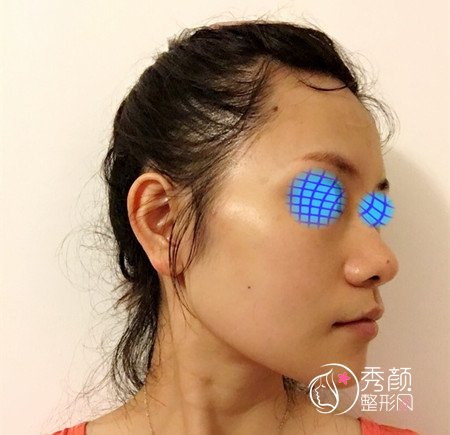 上海华山医院穆雄铮下颌角整形案例。