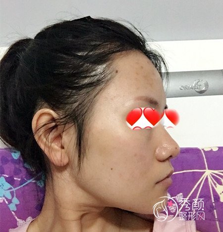 上海华山医院穆雄铮下颌角整形案例。