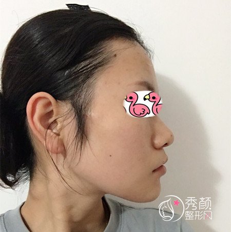 上海华山医院穆雄铮下颌角整形案例。