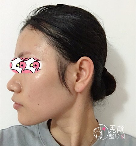 上海华山医院穆雄铮下颌角整形案例。