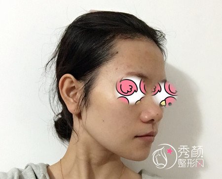 上海华山医院穆雄铮下颌角整形案例。