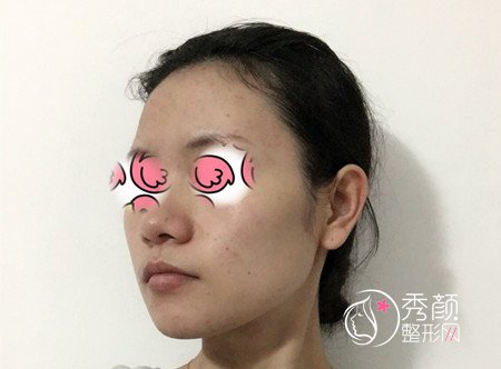 上海华山医院穆雄铮下颌角整形案例。