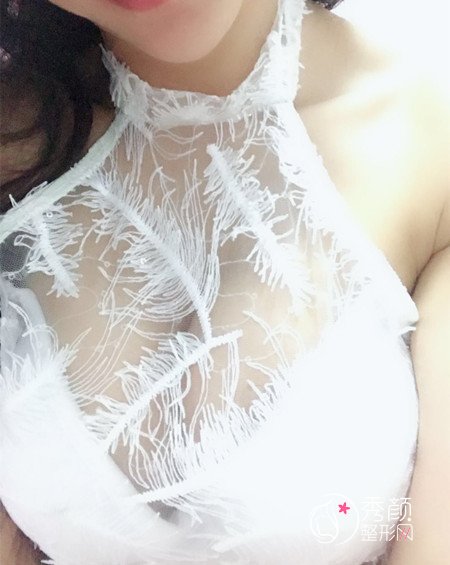 北京壹加壹做的进口娜绮丽假体隆胸,大家看看怎