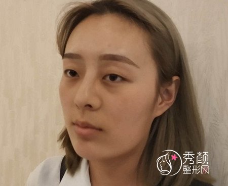 杭州时光下颌角磨骨+隆鼻+割双眼皮案例一枚。