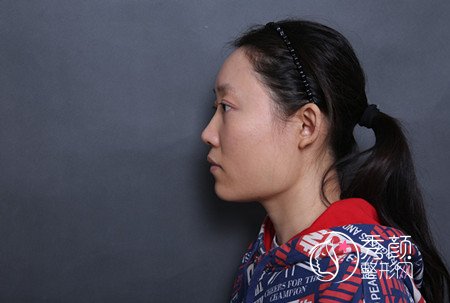 北京圣嘉荣黄大勇下颌角磨骨怎么样,案例分享。