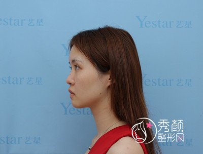 上海艺星许炎龙隆鼻怎么样,案例图。