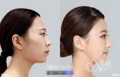 <b>想做颧弓颧骨内推手术的你,一定要慎重！！</b>