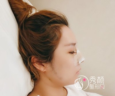 上海薇琳鼻部手术隆鼻案例。