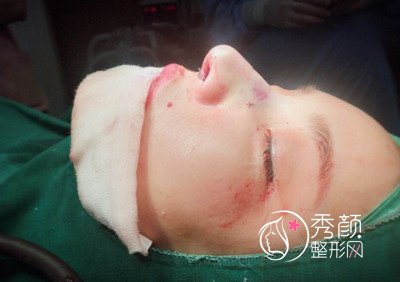 上海容妍国际肋软骨鼻部手术修复案例。