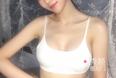 上海华美谢卫国假体隆胸怎么样,案例图。