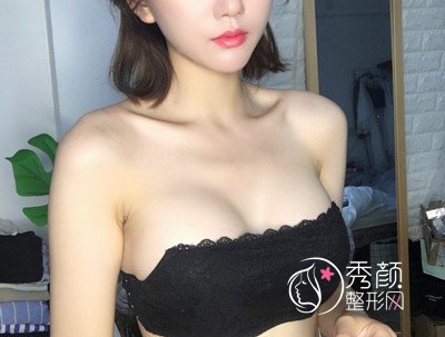 上海华美谢卫国假体隆胸怎么样,案例图。