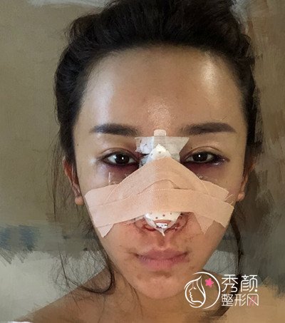 上海九院陈付国肋软骨隆鼻修复案例。