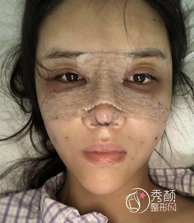 上海华美李健自体脂肪填充+隆鼻案例。