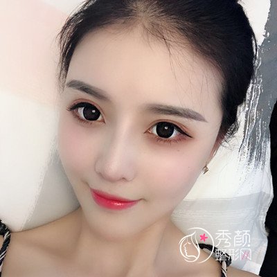 上海华美李健自体脂肪填充+隆鼻案例。