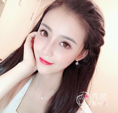 上海华美李健自体脂肪填充+隆鼻案例。