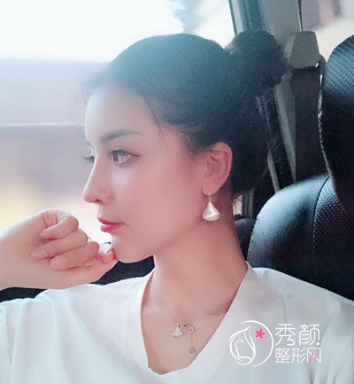 上海华美李健自体脂肪填充+隆鼻案例。