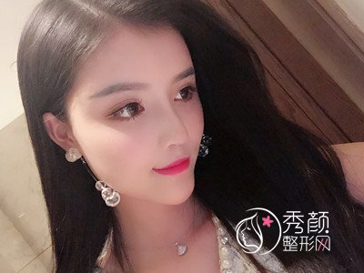 上海华美李健自体脂肪填充+隆鼻案例。